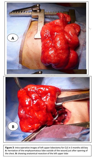 Surgical management of congenital lobar emphysema: A 15 years experience in a tertiary thoracic surgery unit